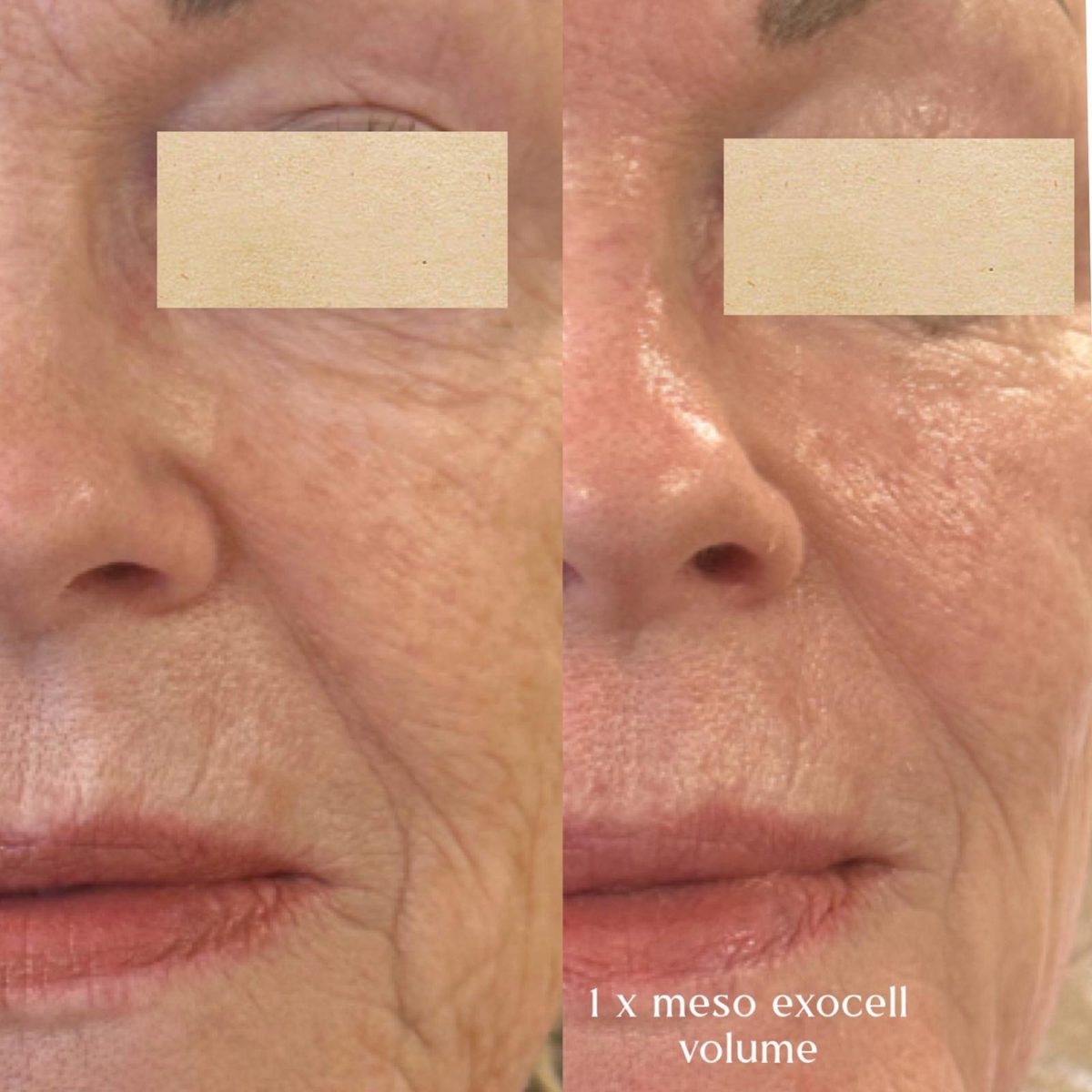 Producentfoto fra Mesoskinline: to nærbilleder forfra af næse-, kind- og mundpartiet med producentens egen billedtekst om Meso Exocell Volume. Øjnene er dækket til af producenten. Viser ikke klinikkens egne klienter.