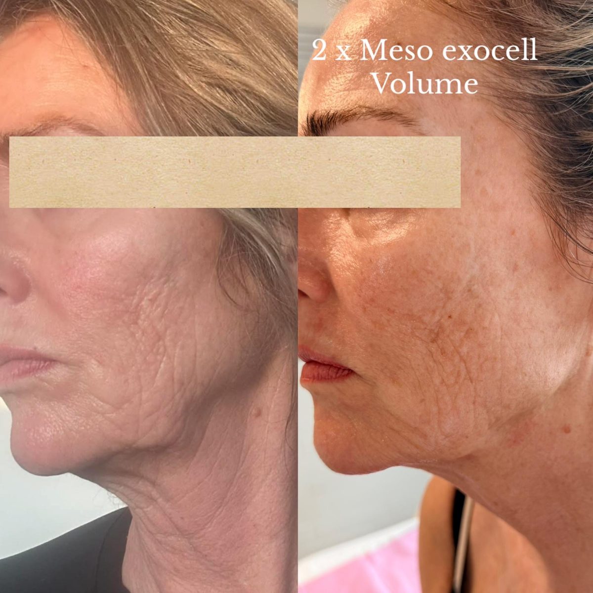 Producentfoto fra Mesoskinline: to profilbilleder af kind- og kæbepartiet med producentens egen billedtekst om Meso Exocell Volume. Viser ikke klinikkens egne klienter.