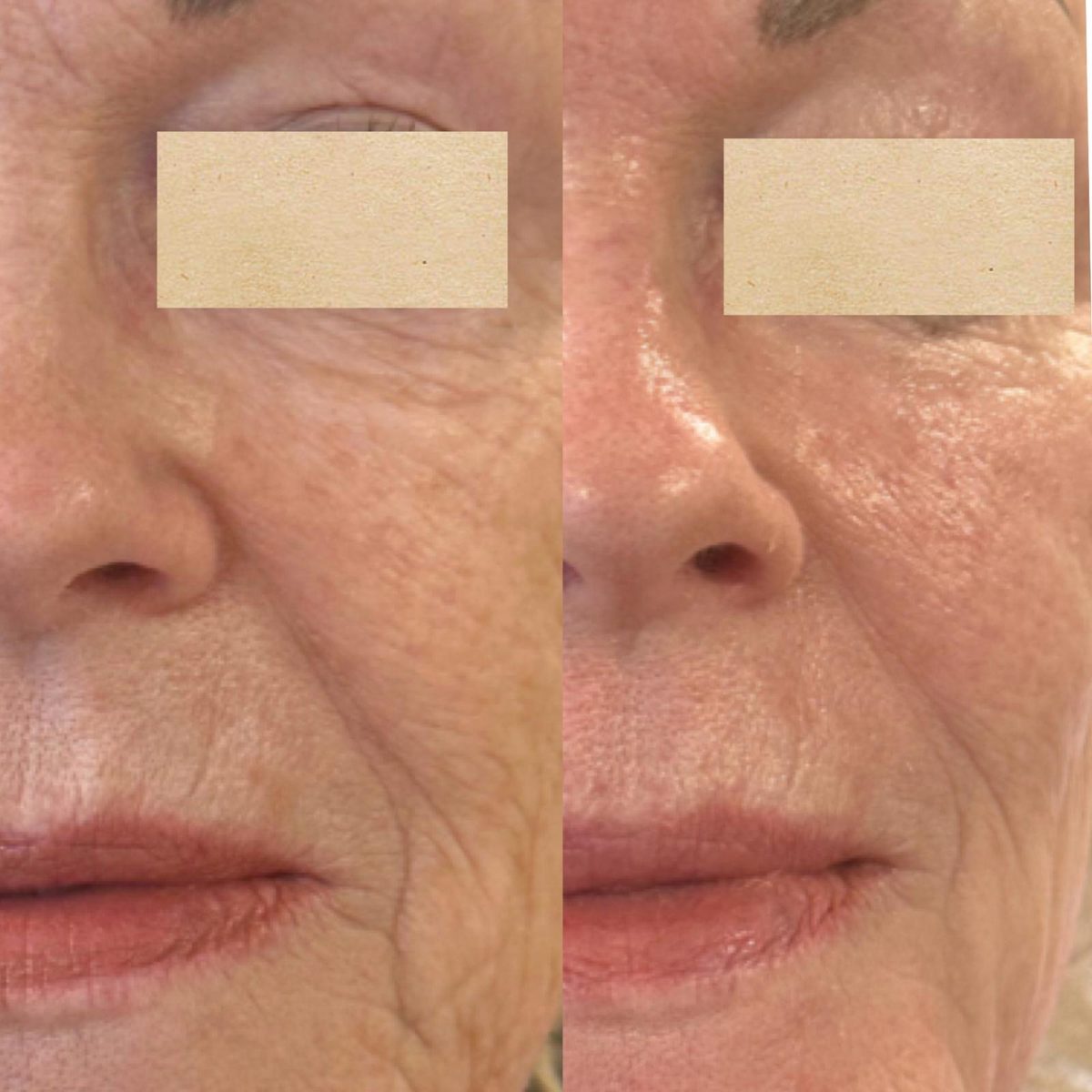 Producentfoto fra Mesoskinline: to nærbilleder af næse-, kind- og mundpartiet, med øjnene dækket af beige bjælker. Viser ikke klinikkens egne klienter.