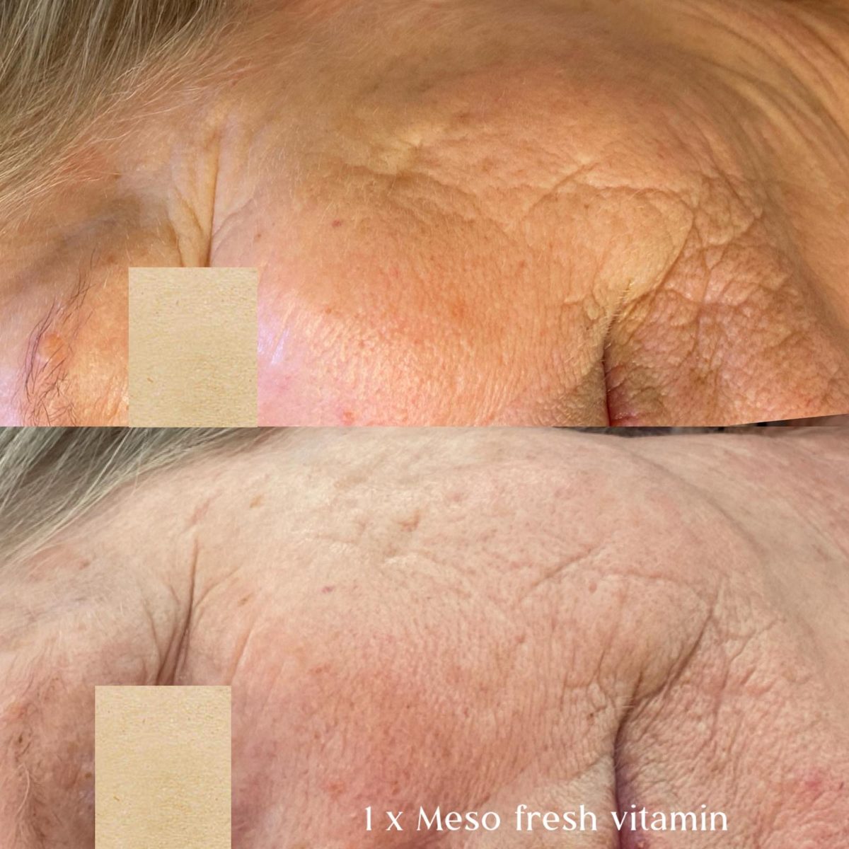 Producentfoto fra Mesoskinline: to nærbilleder af pandepartiet med producentens egen billedtekst om Meso Fresh Vitamin. Viser ikke klinikkens egne klienter.