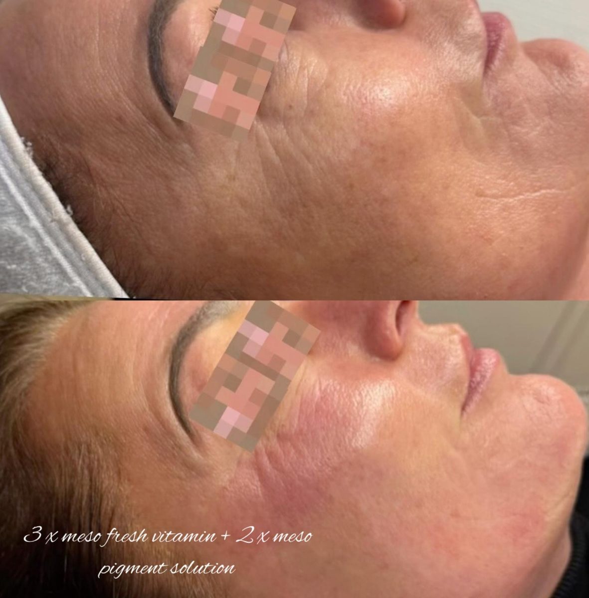 Producentfoto fra Mesoskinline: to billeder af ansigtet i profil med producentens egen billedtekst om et kombineret forløb med Meso Fresh Vitamin og Meso Pigment Solution. Viser ikke klinikkens egne klienter.