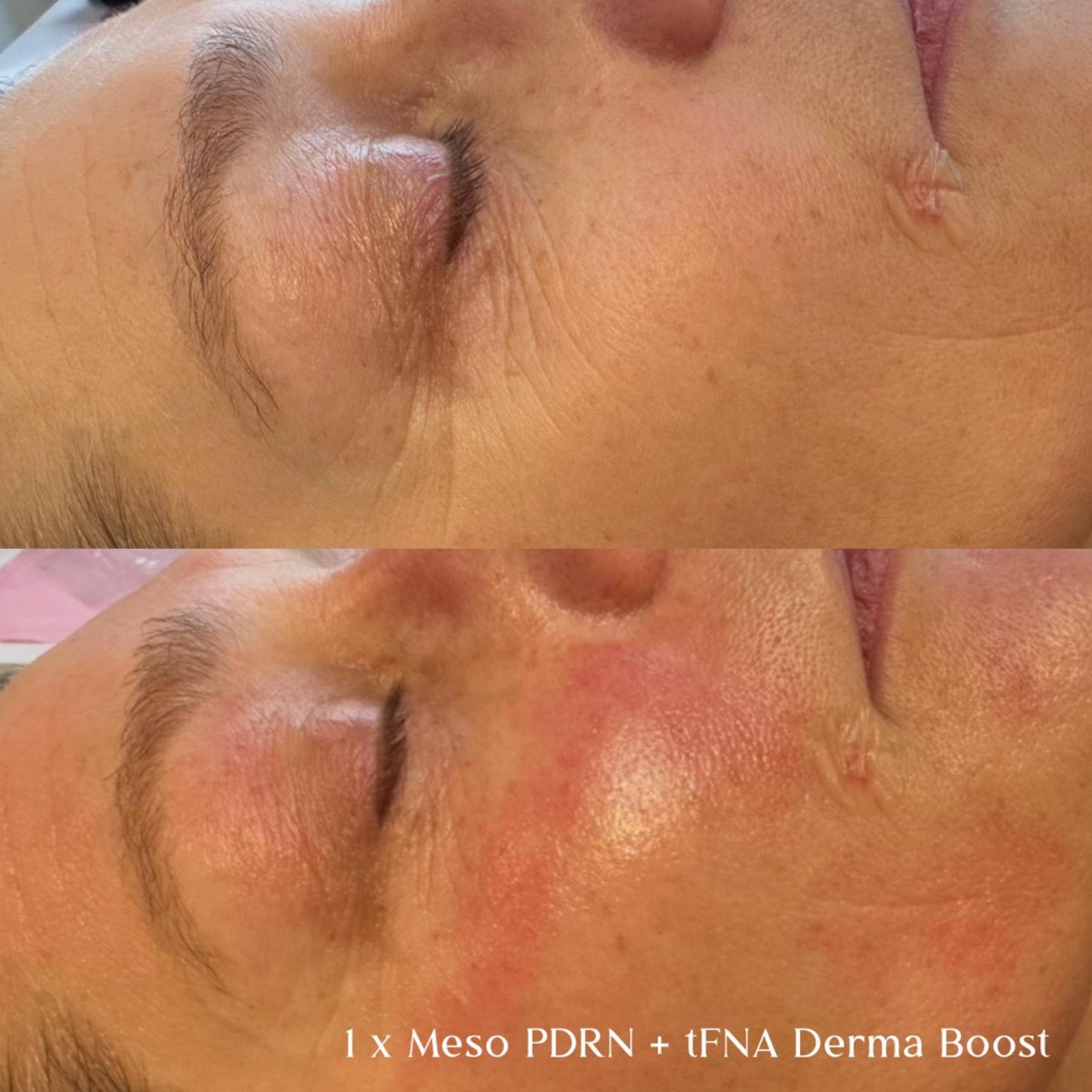 Producentfoto fra Mesoskinline: to billeder af øjen- og kindpartiet set fra siden med producentens egen billedtekst om Meso PDRN + tFNA Derma Boost. Viser ikke klinikkens egne klienter.